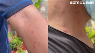 澎湖200人求診　大片紅疹畫面曝光