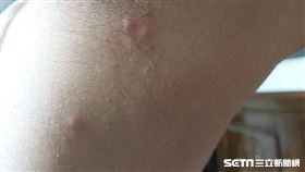 陳大姐住在澎湖40年，最近因為沒有原因的疹子相當困擾。（圖／民眾提供）