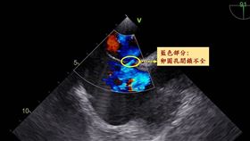 中風,失明,工程師,心臟,卵圓孔閉鎖不全（圖／中醫大新竹附醫提供）