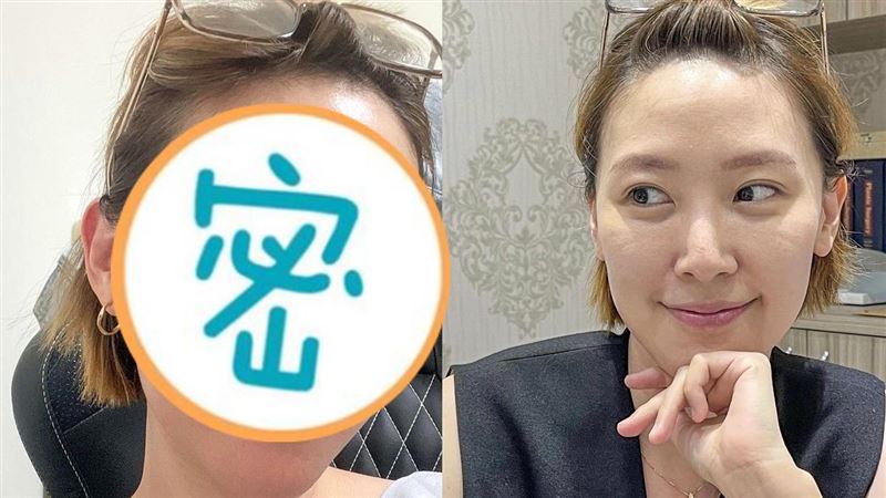 李懿曝微整對比照　自爆14年前就弄