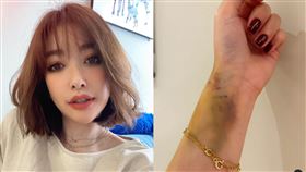  許維恩「健身舉太重」微血管爆裂！　可怕瘀青嚇傻網：看起來超痛。許維恩臉書