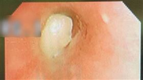 拔牙後找不到牙齒　竟出現這個器官裡(台北慈劑醫院)