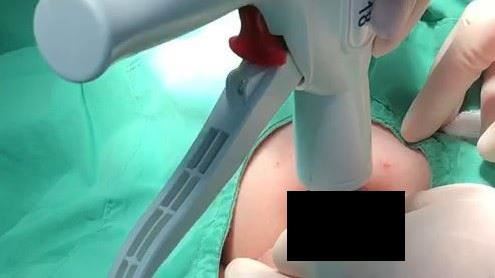 夫妻為兒子「包皮」吵架　醫師說話了