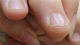 ▲指甲出現凹槽。（圖／翻攝自爆系知識家臉書）