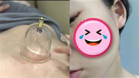 拔罐（合成圖／資料照、翻攝自Dcard）