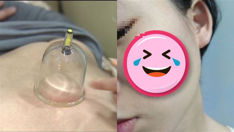 女大生拔罐「自製腮紅」卸妝後尷尬了