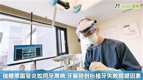 名家專用／NOW健康／鍾文宸醫師指出，若口腔清潔習慣不良，牙周病有很高的機率會復發，導致植牙後的使用年限縮短，唯有維持良好的口腔清潔習慣，才能讓植牙和自然牙使用長久。(勿用)