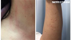 澎湖,屏東,墾丁,恆春,毛毛蟲,怪病,紅疹,皮膚