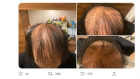 接種狂脫髮！帥哥打完疫苗變禿頭　2個月後曬對比照網嚇瘋（圖／翻攝自@irushige推特）