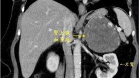 游智欽醫師指出，「腎上腺血管瘤」是非常罕見的腎上腺良性腫瘤，全世界目前只有約60例的病例報告。（圖／台北慈院提供）