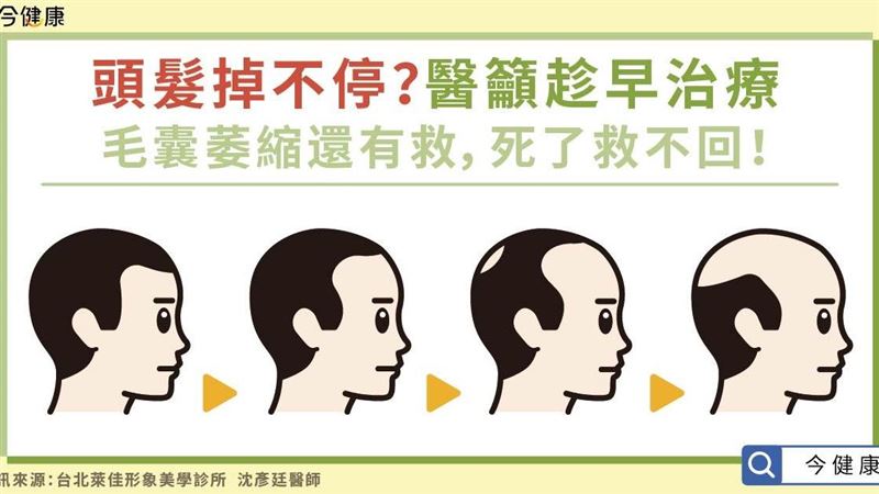 頭髮掉不停？醫籲趁早開始治療！