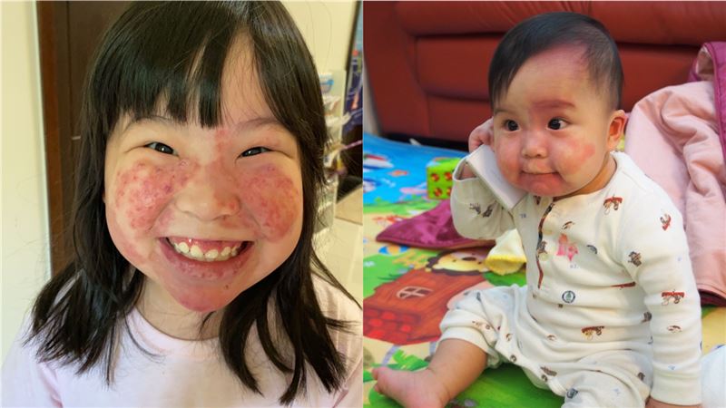 女童臉部血管畸形　27次手術曝心願