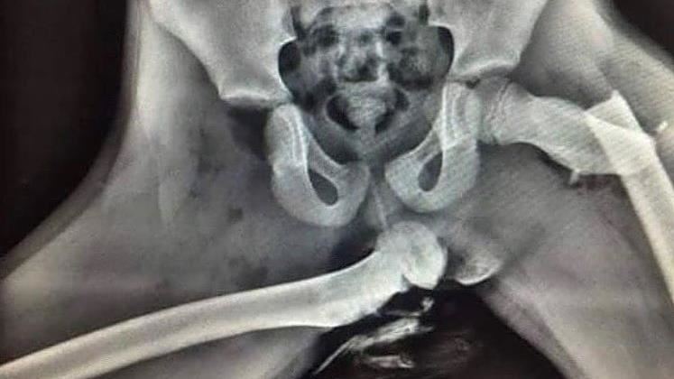 翹腳坐副駕！她車禍「腿骨插進屁股」
