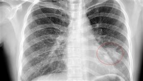 生活正常沒抽菸　婦肩頸痛竟罹肺腺癌合併骨轉移（圖／亞大醫院提供）