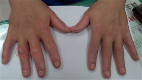 乾癬性關節炎(台中醫院提供)