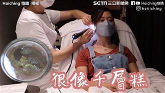 2年沒挖！港妹驚見巨無霸千層糕耳屎