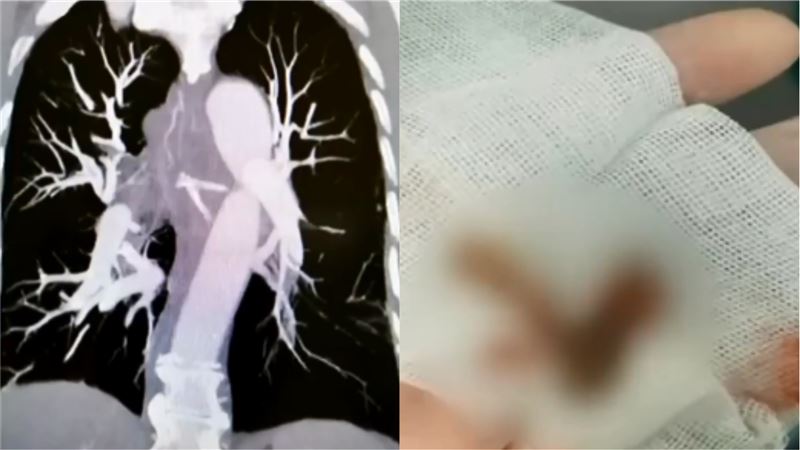 翁被雞骨卡喉嚨　喝粥硬吞慘食道穿孔