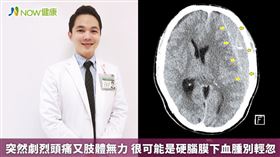 名家專用／NOW健康／亞東醫院神經外科主治醫師岑昇信表示，患者往往因為血腫的壓力，造成腦壓增加及神經壓迫，而出現肢體無力、意識改變的問題，需要緊急手術將血腫清除。(勿用)