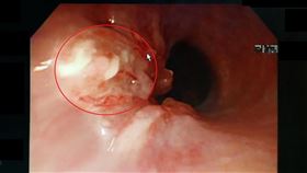大千綜合醫院肝膽腸胃科醫師李斯凱表示，喝酒、抽菸、吃檳榔、及常吃刺激性、醃漬類或太燙的食物，都是罹患食道癌的高危險因子。（圖／大千綜合醫院提供）