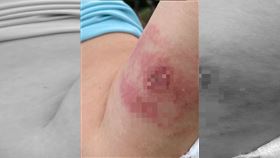 派遣工，遭蜜蜂螫傷，蜂窩性組織炎，抗議被剝奪工作權，不聞不問 (翻攝畫面)