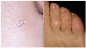 病毒疣ｖｓ雞眼（維基百科）