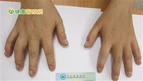 根據國內乾癬性關節炎生物製劑健保給付規範，對於傳統光照療法與口服藥仍無法改善的中度至重度乾癬性關節炎患者，可在皮膚科與風濕科雙科別醫師評估下選擇使用生物製劑，透過精準鎖定發炎因子的方式抑制皮膚與關節症狀。