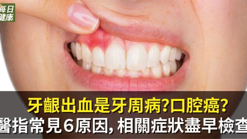 牙齦出血是牙周病？　有症狀盡早檢查