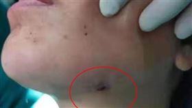 智齒常發炎不拔掉！全靠成藥止痛…女子臉頰「穿破1個洞」（圖／翻攝自《現代快報》）