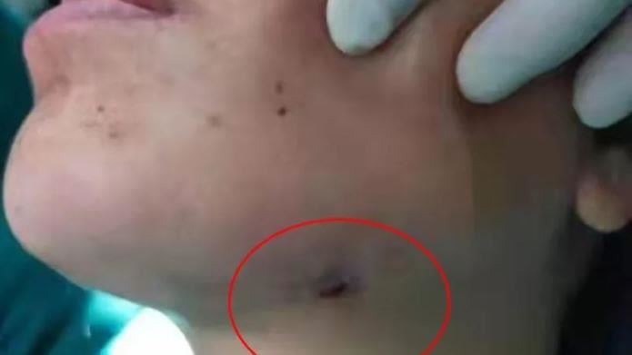 智齒常發炎不拔　女子臉頰穿破1個洞