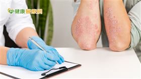 現階段乾癬有許多治療方式，除了民眾較熟悉的外用藥與口服藥，現階段也有生物製劑作為治療選擇。洪崧壬主任分享，針對病患狀況，輕中度的患者會使用外用藥搭配口服藥，而中重度患者若是使用口服藥治療仍不見效果，便可以評估使用生物製劑。