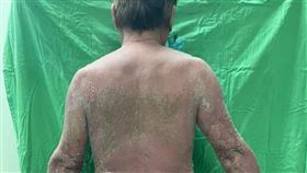 ▲澎湖發生全台首例接種疫苗後，全身發生皮膚潰爛全台首例。（三總澎湖分院提供）