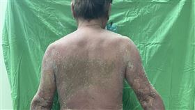 ▲該名70歲男性在澎湖合格醫療機構完成第一劑新冠疫苗注射後，隔日全身即出現紅疹，5日後全身紅疹處出現膿皰、並發燒至38.3度，第8日皮膚大面積脫落倦怠而入院就醫，初步診斷為急性廣泛性發疹性膿皰症，無法排除史蒂芬強森症-鬆懈性表皮溶解症。打完疫苗不良反應 澎湖發生全台首例接種疫苗後，全身發生皮膚潰爛全台首例。（三總澎湖分院提供）