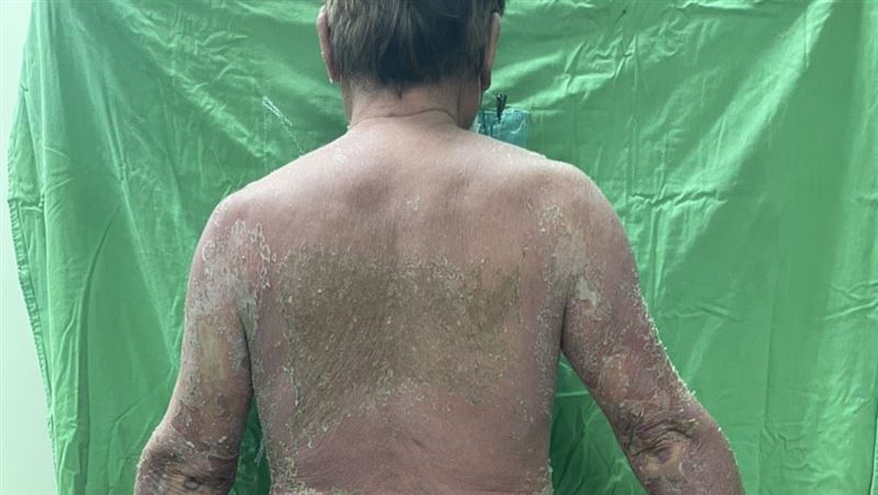 澎湖男打疫苗長膿皰　疑發疹性膿皰症
