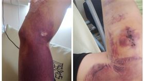 高雄,BNT,疫苗,血疹