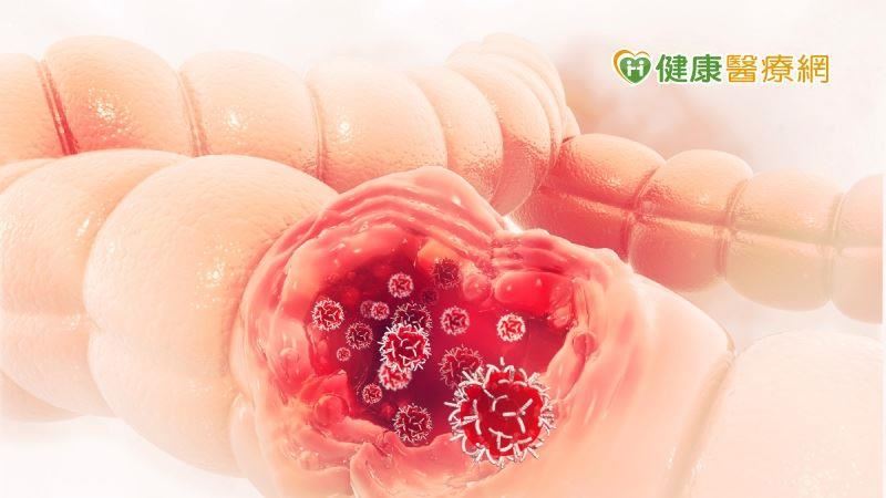 每年定期篩檢大腸癌　有效降低發生率