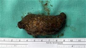 胃部糞石(南投醫院提供)