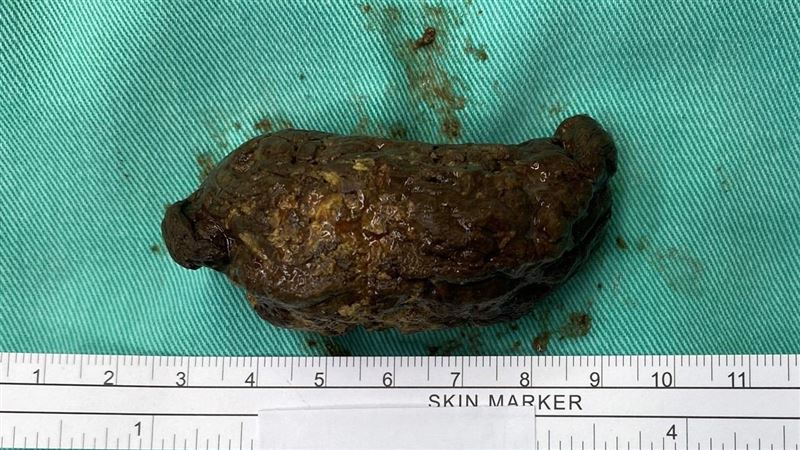 她胃長「7公分糞石」　爆愛吃這兩味