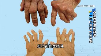全球首發現！類風濕性關節炎減短壽命