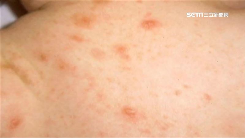 疥瘡多恐怖？醫護：光聽到就癢起來了