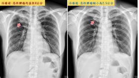 「次世代基因定序」治療奏效　肺腺癌第四期熟女成功續命(中國附醫提供)