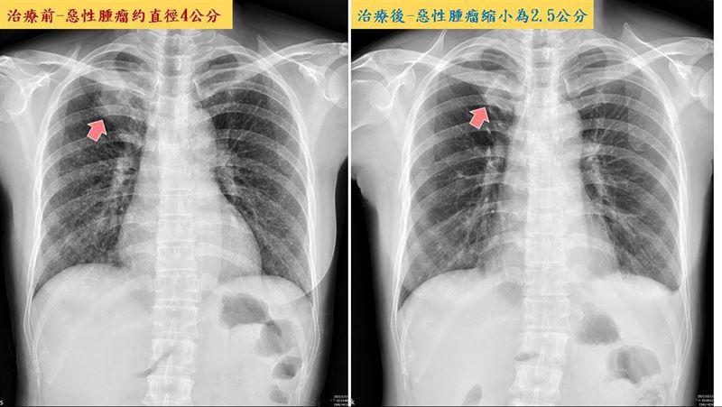 她肺腺癌第四期　靠這治療重回健身房