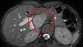 台中慈濟醫院外科部主任余政展醫師從肝臟核磁共振檢查影像確認，腫瘤位於肝臟後面、脊椎旁邊，已經大到擠開腹腔多條大血管（圖／台中慈院提供）
