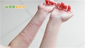 蕁麻疹發作時會在身體各處出現疹塊，接著膨起形成疹塊，大多集中在手臂、腿部，甚至臉部。