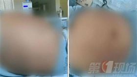 醫生揪出少女肚子裡的「神秘疾病」。（圖／翻攝自第一現場微博）