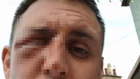 迷你型炸彈！男微波雞蛋40秒　「湯匙挖出」秒爆險毀容（圖／翻攝自Gary McDougall TikTok）
