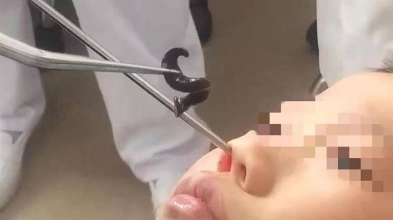 男童鼻塞「異物蠕動」夾出5cm螞蝗