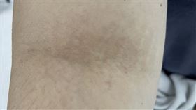 黑色棘皮症示意畫面，除脖子也會在腋下或手肘曲側處（圖／烏日林新醫院提供）