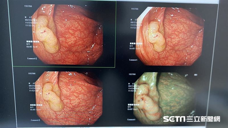 醫師：大腸癌最大威脅就是「無症狀」