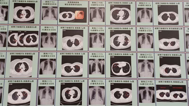 胸腔科醫師：最可怕的肺癌不是肺腺癌