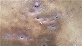 汗腺炎,化膿,治療,（圖／新竹台大分院提供）